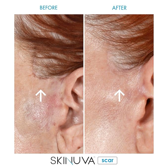 Skinuva® Next Generation Scar Cream - Image 9
