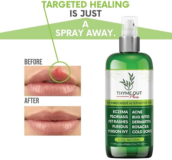 Plus Eczema Treatment, Psoriasis Treatment Treats Acne, Dermatitis, Cold Sores - Image 6