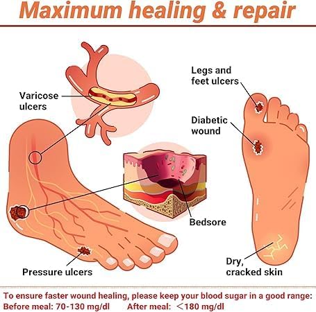 iShanCare® Diabetic Wound Ulcer Cream - Image 3