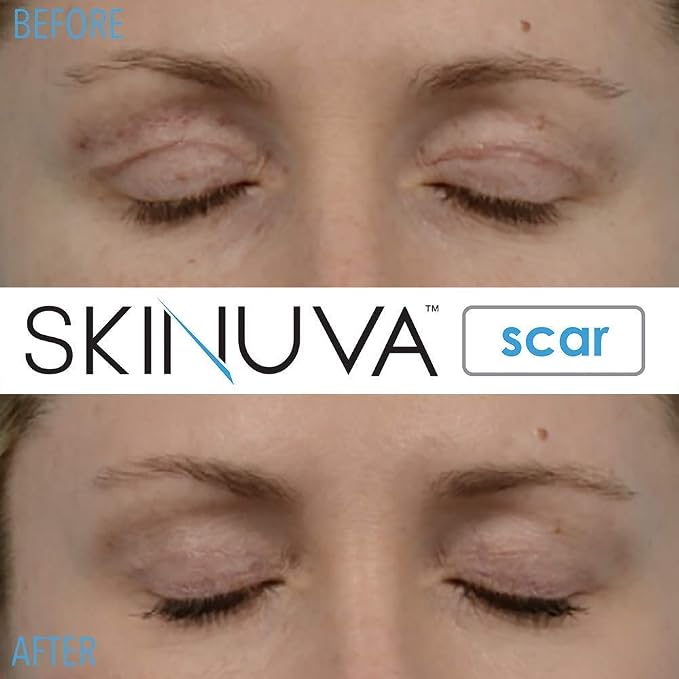 Skinuva® Next Generation Scar Cream - Image 8