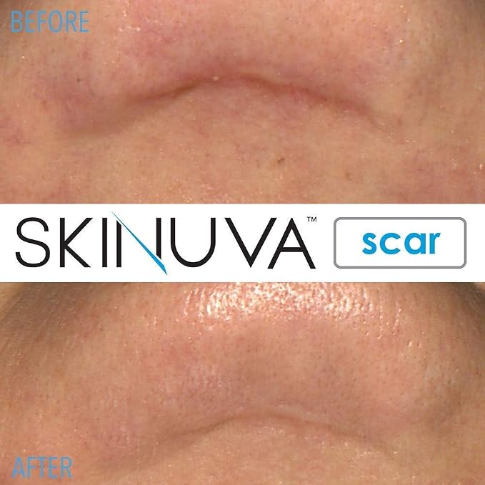 Skinuva® Next Generation Scar Cream - Image 7