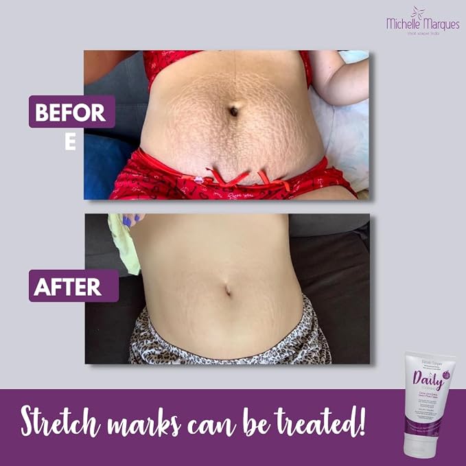 Stretch Mark Cream, Soften and Reduce the Appearance, Provides Hydration - Image 6