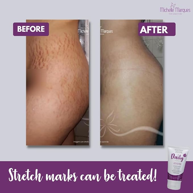 Stretch Mark Cream, Soften and Reduce the Appearance, Provides Hydration - Image 5