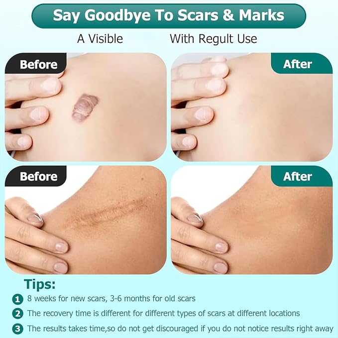 Advanced Scar Gel for Surgical Scars, Stretch Marks, Keloids - Image 2