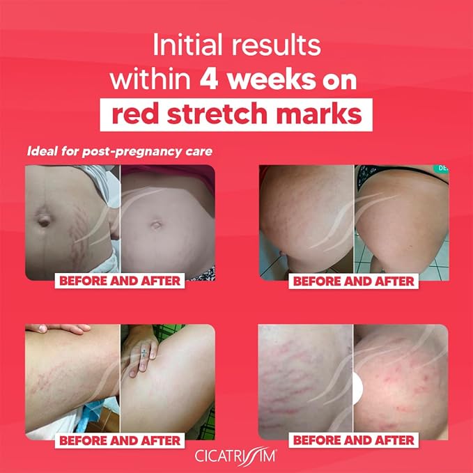 Cicatrissim Red Stretch Mark Cream - Image 3