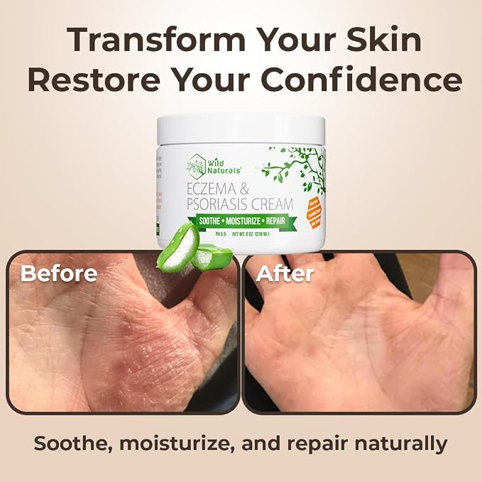 Wild Naturals Eczema & Psoriasis Cream - Image 5