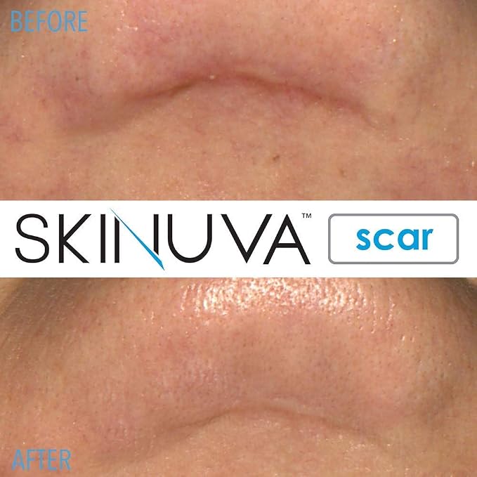 Skinuva® Next Generation Scar Cream - Image 7