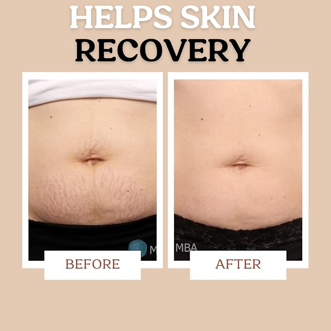 Roe Wellness Stretch Mark Cream - Image 5