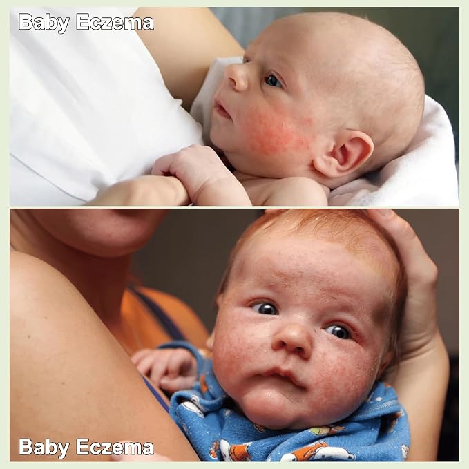 Baby Eczema Cream - Image 4