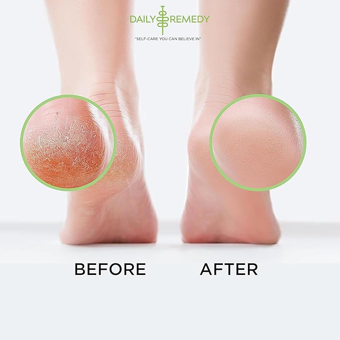 Tea Tree Oil Foot Soak with Epsom Salt - Image 5