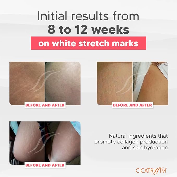 Cicatrissim White Stretch Mark Cream - Image 3