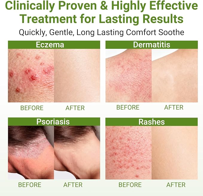 Eczema Cream, Dermatitis & Rashes Treatment, Moisturizer - Image 2
