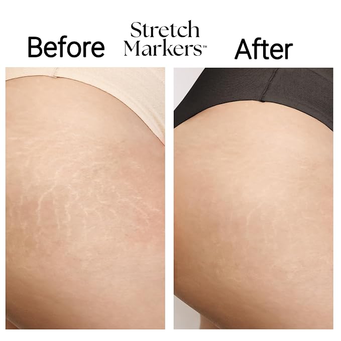 StretchMarkers Therapy Stretch Mark Cream – Visibly Reduces and Treats - Image 5