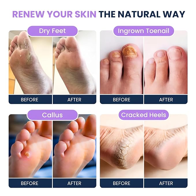 FOOT CURE Premium Epsom Salt Foot Soak - Image 4