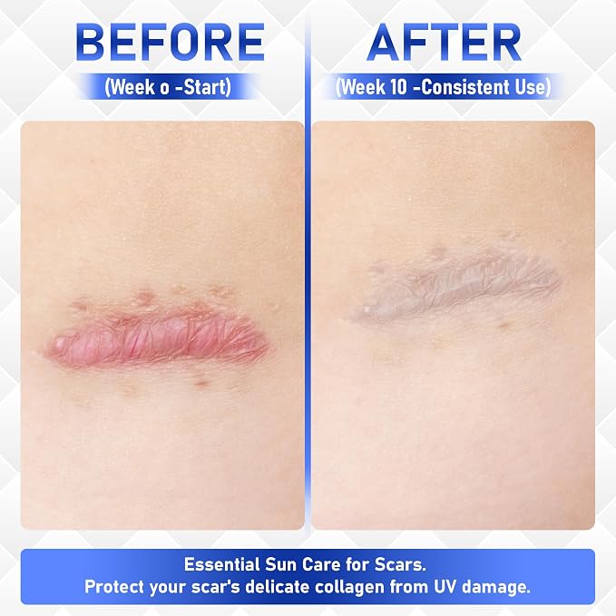 Silicone Scar Cream Gel - Image 7