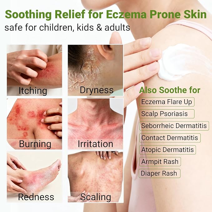 Eczema Cream, Dermatitis & Rashes Treatment, Moisturizer - Image 4