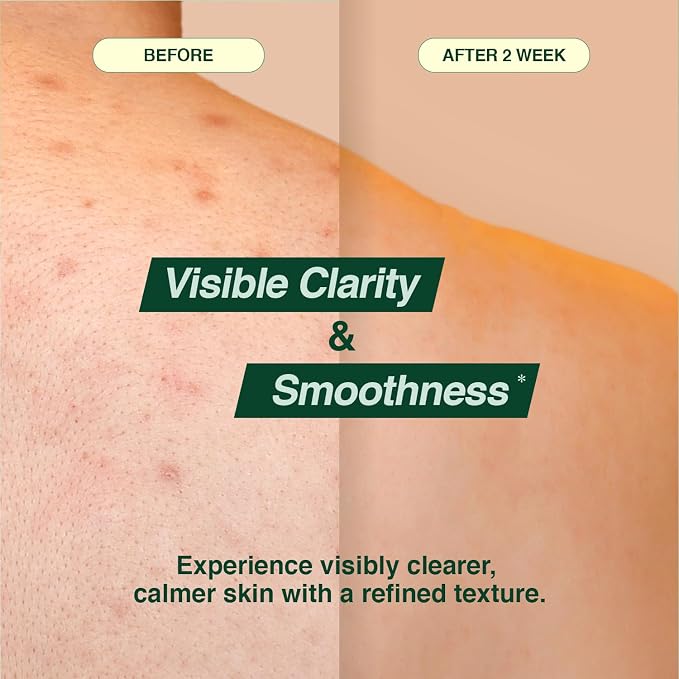 Tea Tree 90 Clear Body Mist for acne skin | 360° Moisture Spraying - Image 3