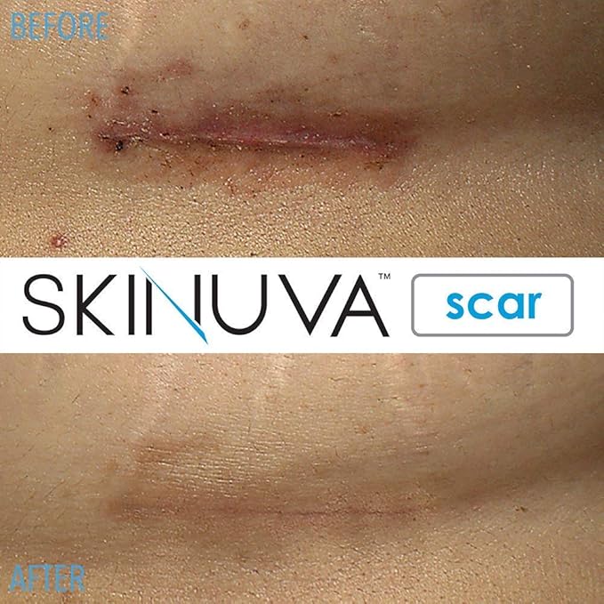 Skinuva® Next Generation Scar Cream - Image 6