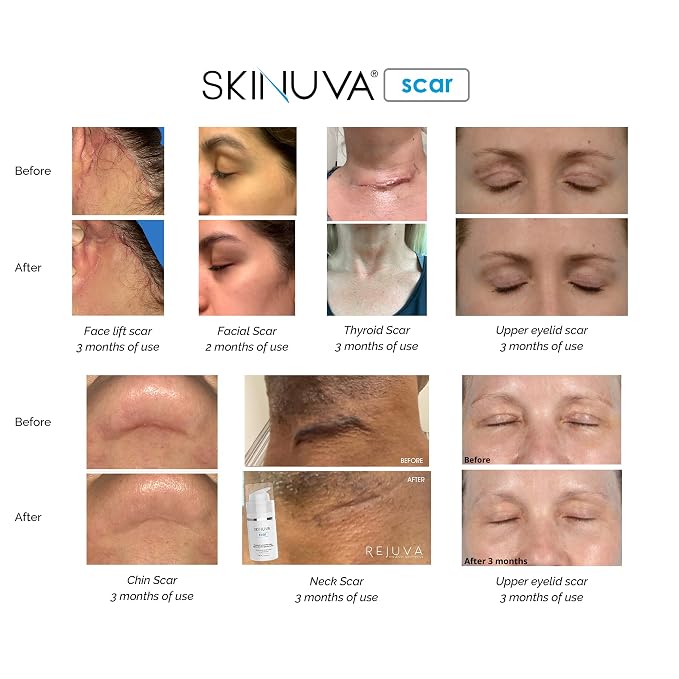 Skinuva® Next Generation Scar Cream - Image 6