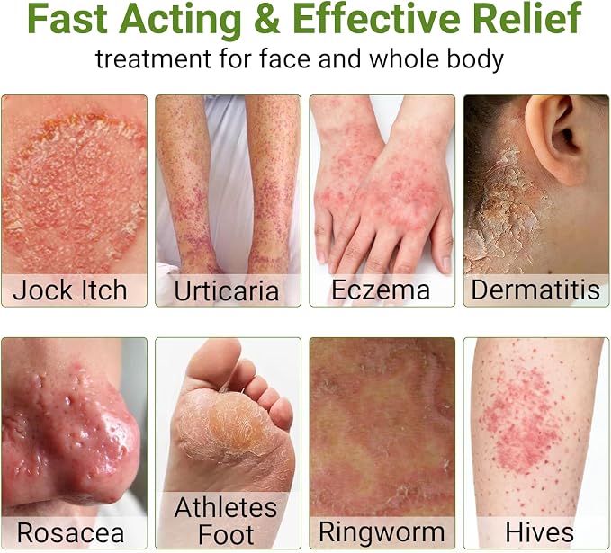 Eczema Cream, Dermatitis & Rashes Treatment, Moisturizer - Image 6