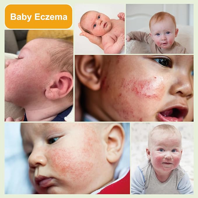 Baby Eczema Cream - Image 3