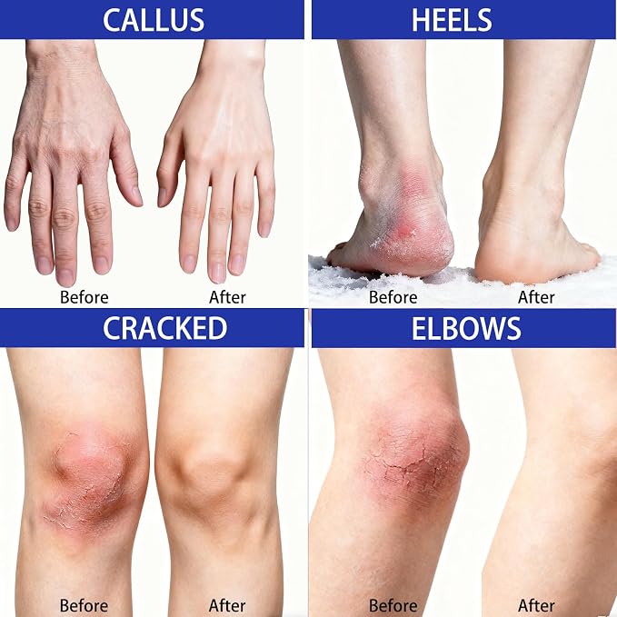 40% Urea Foot Cream with 2% Salicylic Acid, Urea Cream 40 Percent - Image 4