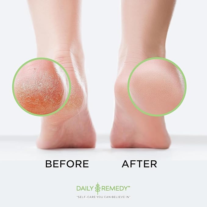 EXTRA STRENGTH Tea Tree Oil Foot Soak - Image 6