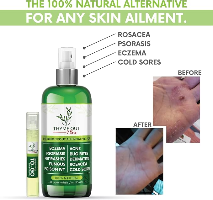 Plus Eczema Treatment, Psoriasis Treatment Treats Acne, Dermatitis, Cold Sores - Image 2