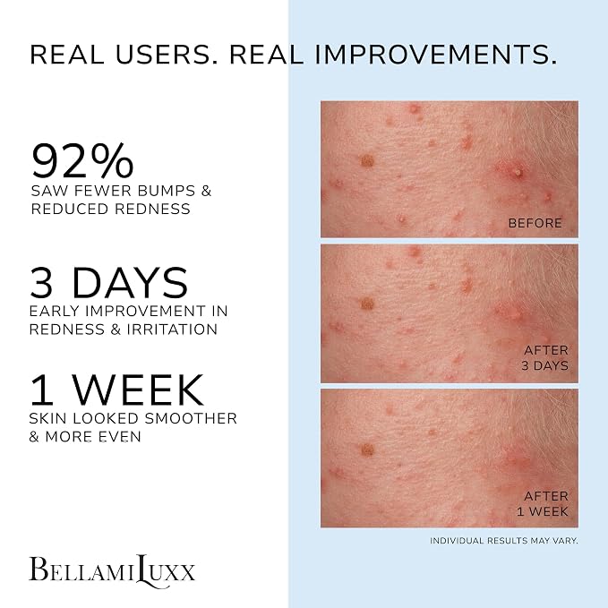 Folliculitis Acne Lotion for Body: Helps Reduce Itch, Body Acne, Bumps & Uneven - Image 2