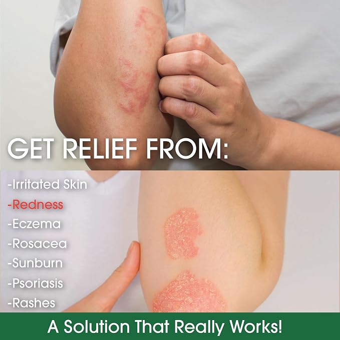 Manuka Honey Eczema Cream Moisturizing Lotion - Image 4