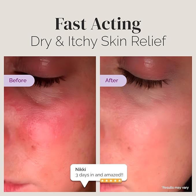 Puriya National Eczema Association Accepted Cream 2 oz, Dry Itchy Skin Relief - Image 3
