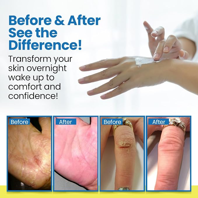 Dermasolve Full Body Eczema Relief Lotion Cream - Image 3