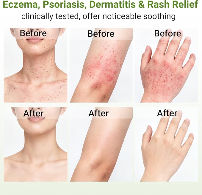 Eczema Cream, Dermatitis & Rashes Treatment, Moisturizer - Image 3