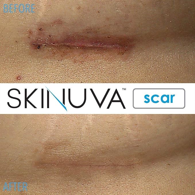 Skinuva® Next Generation Scar Cream - Image 6