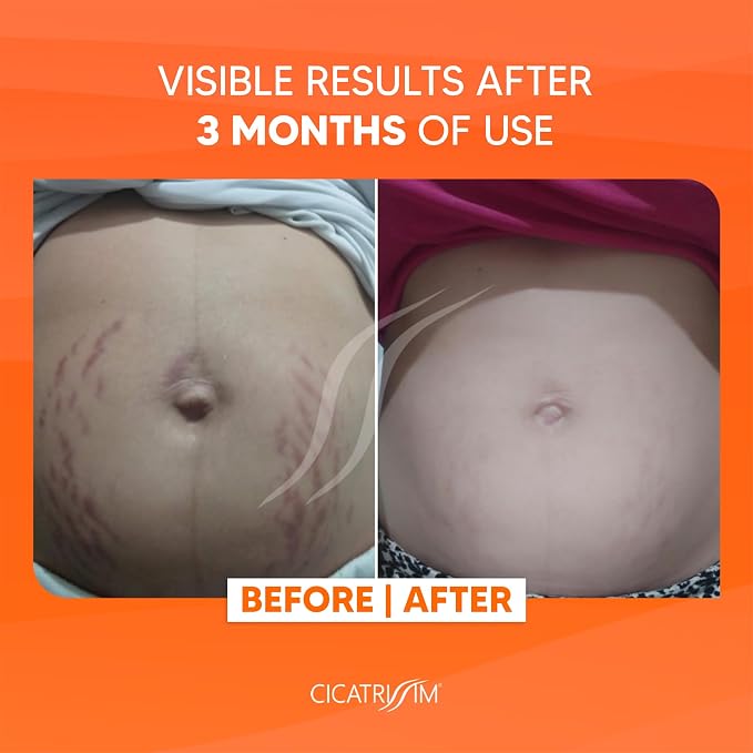 Cicatrissim Stretch Mark Cream for Red and White Striae - Image 3