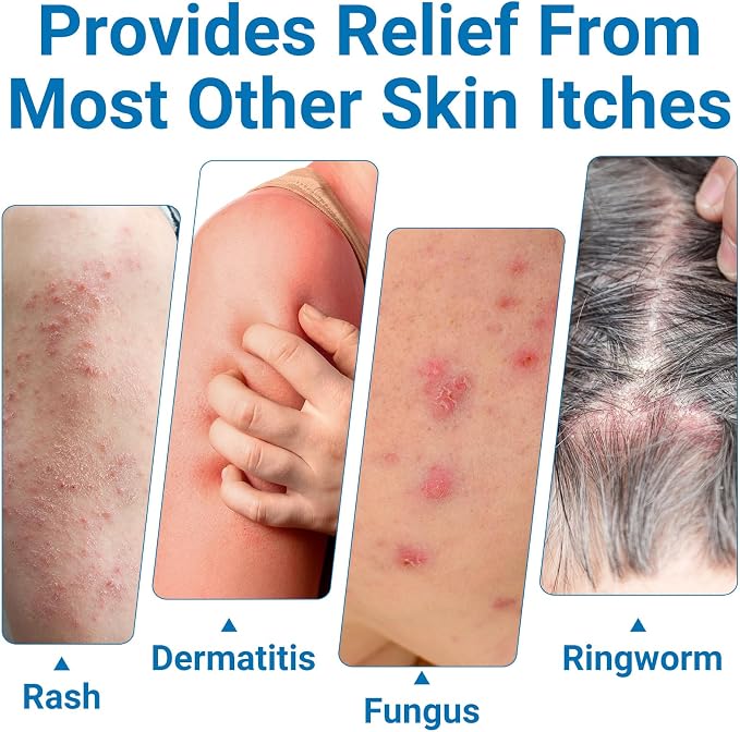 ishancare Anti Itch Cream Extra Strength, Outdoor Portable Itchy Skin Relief - Image 5