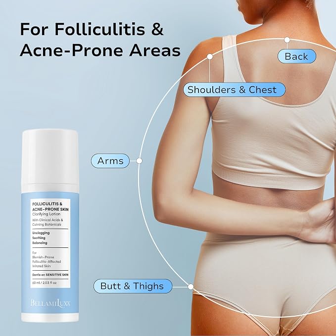 Folliculitis Acne Lotion for Body: Helps Reduce Itch, Body Acne, Bumps & Uneven - Image 4