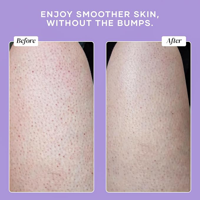DERMAdoctor KP Bump Eraser Body Scrub - Image 6