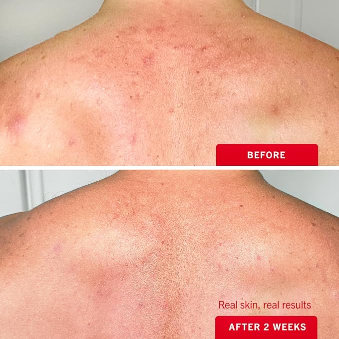 First Aid Beauty Body Acne Spray - Image 4