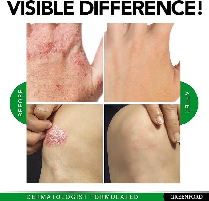 Greenford Eczema Treatment & Support - Image 7