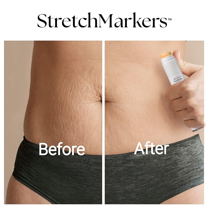 StretchMarkers Therapy Stretch Mark Cream – Visibly Reduces and Treats - Image 6
